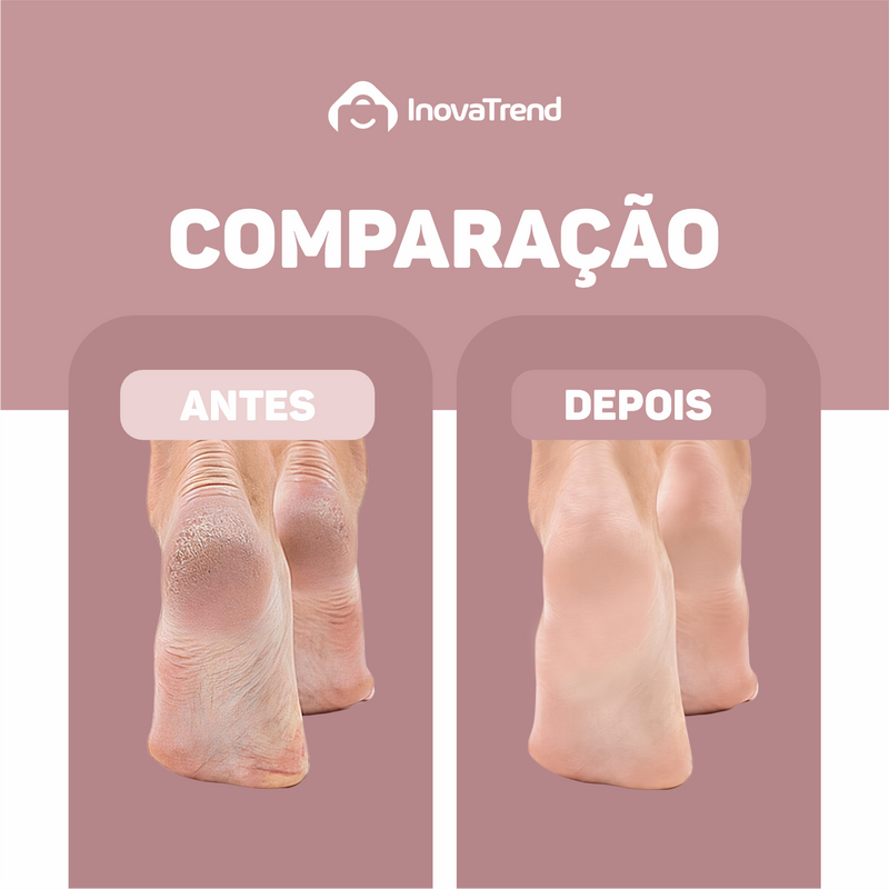 Pedicure Pro 3.0® - Esfoliador Elétrico + Livro Digital com Dicas Exclusivas + Creme Hidratante Intensivo 240g - Leve 3 Itens Pelo Preço de 1